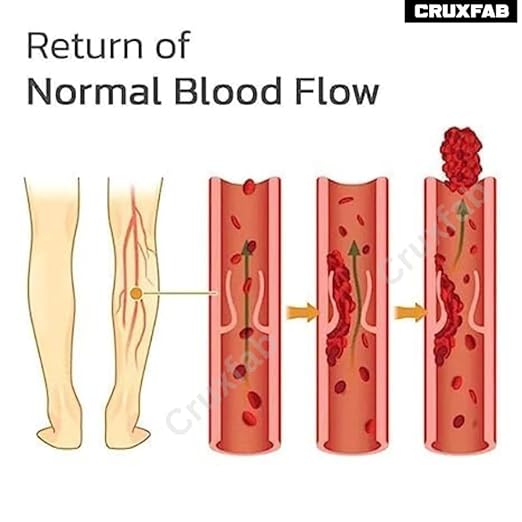 Varicose Veins Patches