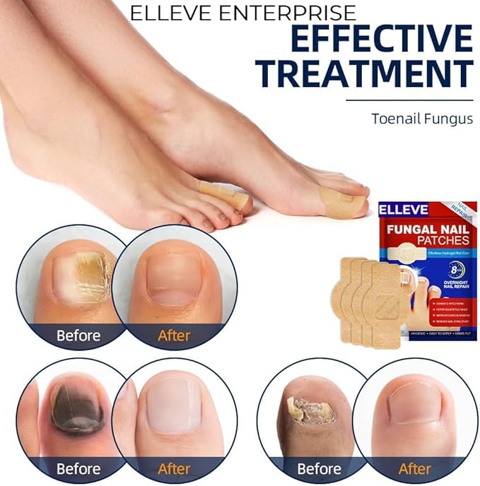 Advanced Fungal Nail Patch Treatment – Powerful Antifungal Solution | Targets Nail Fungus at the Root | Easy-to-Use Patch for Toenail & Fingernail | 21 Patches