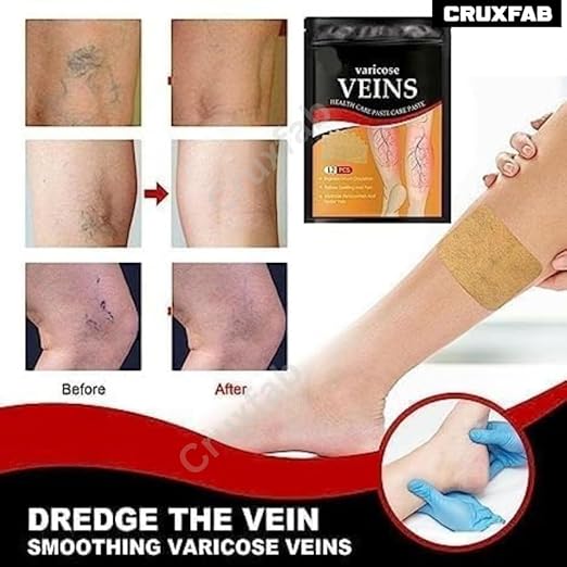 Varicose Veins Patches